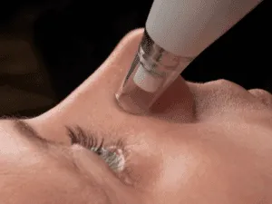 Macro di trattamento viso vacuum focalizzato sul naso con tecnologia di micro-aspirazione per rimozione punti neri e impurità cutanee.